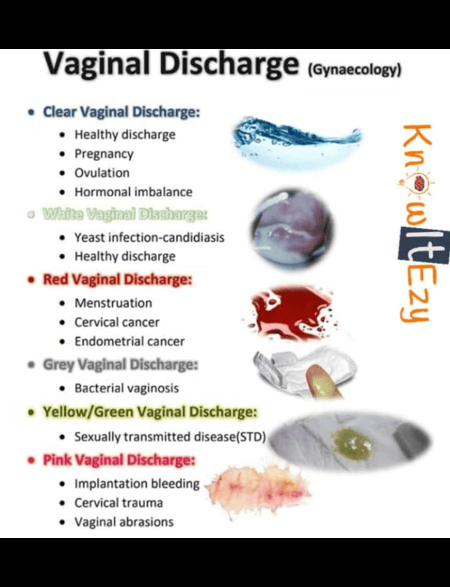 Abnormal Vaginal Discharge